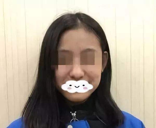隆鼻修復(fù).jpg