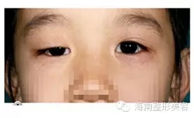 上眼瞼提肌無力.webp.jpg