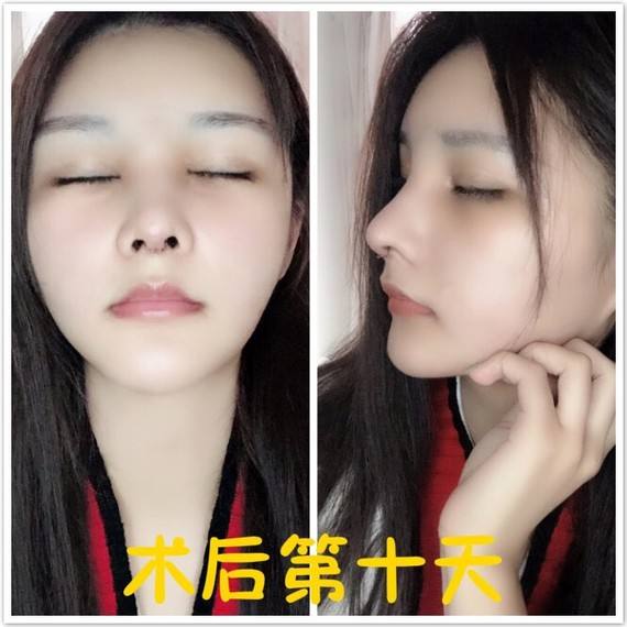 自體軟骨.jpg
