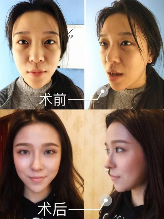 自體耳軟骨效果.jpg