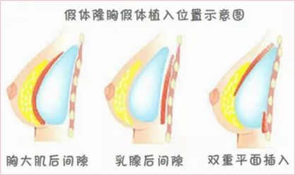 假體隆胸位置-林賢超