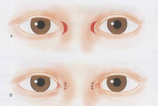 開眼角術(shù)前.jpg