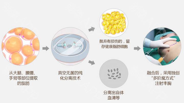 自體隆胸.jpg