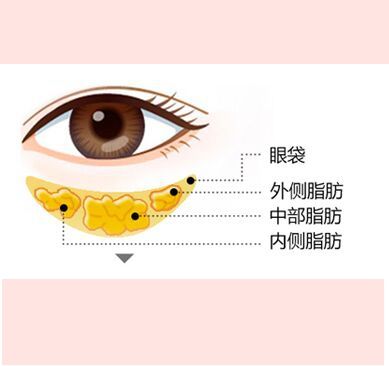 眼袋.jpg