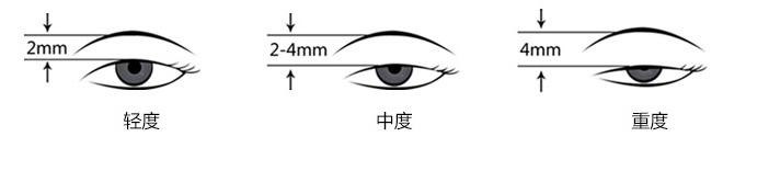 上瞼下垂矯正.jpg