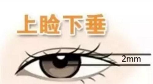 上瞼下垂手術(shù).jpg