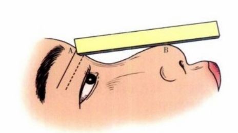 矯正隆鼻.jpg