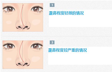 歪鼻矯正.jpg