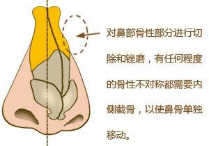 歪鼻矯正.jpg