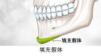 假體墊下巴.jpg