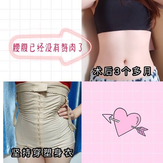 腰部吸脂-1