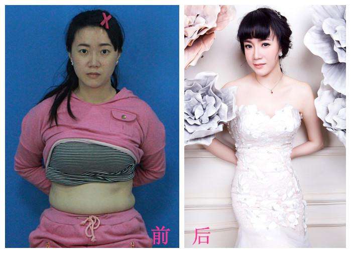 腹部吸脂.jpg