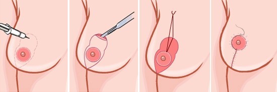乳房下垂矯正
