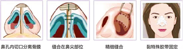 鼻尖整形